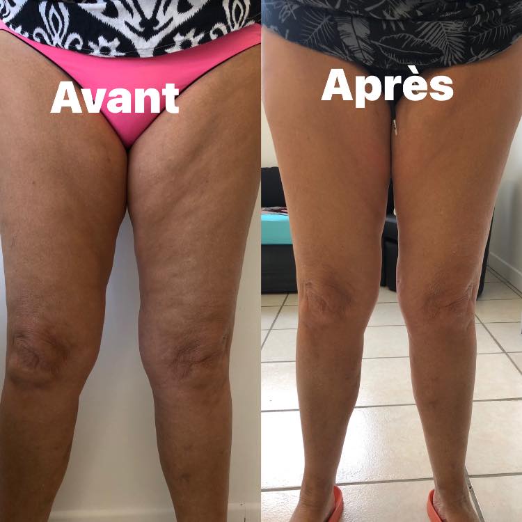 Body esculpt