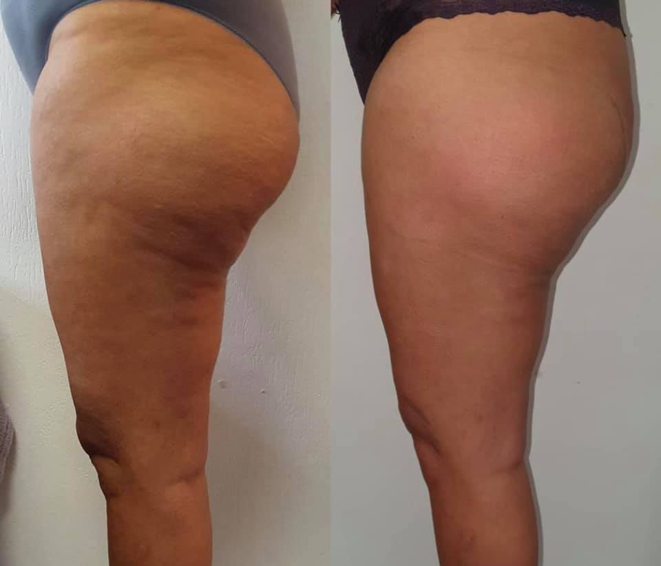 Body esculpt